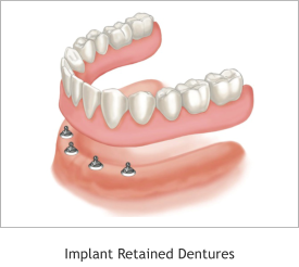 Implant Retained Dentures